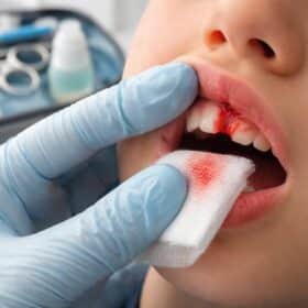 découvrez comment soigner efficacement un frein labial déchiré après une chute grâce à notre guide complet des premiers secours, avec des conseils pratiques pour prévenir l'infection et favoriser la guérison.